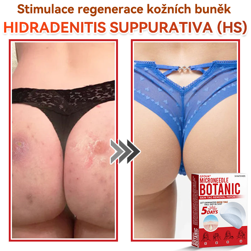 🔥✅GFOUK® Mikrojehličková botanická náplast na odstranění bradavic