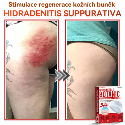 🔥✅GFOUK® Mikrojehličková botanická náplast na odstranění bradavic