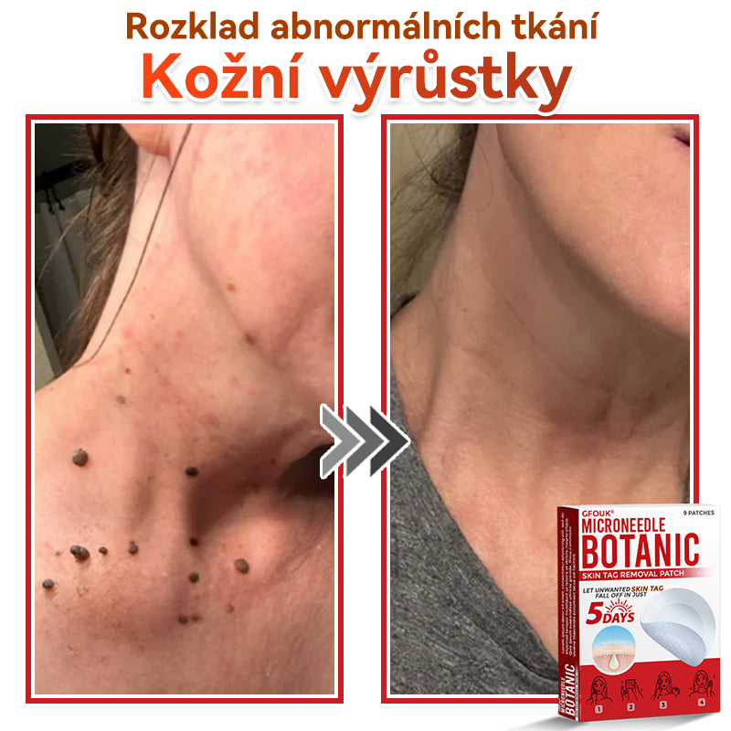 🔥✅GFOUK® Mikrojehličková botanická náplast na odstranění bradavic