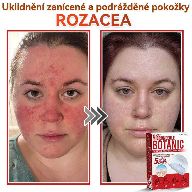 🔥✅GFOUK® Mikrojehličková botanická náplast na odstranění bradavic