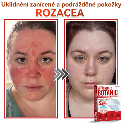 🔥✅GFOUK® Mikrojehličková botanická náplast na odstranění bradavic