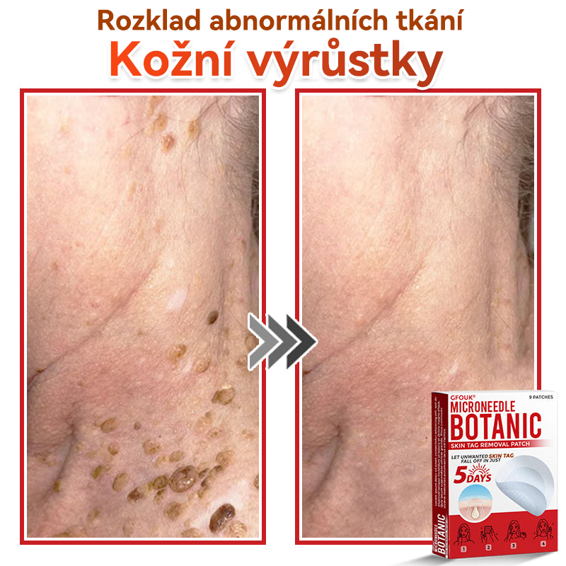 🔥✅GFOUK® Mikrojehličková botanická náplast na odstranění bradavic